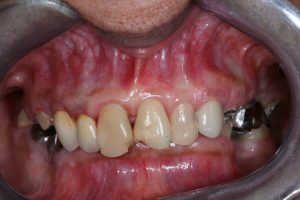 dental case picture - case4
